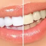 Blanqueamiento Dental