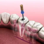 Endodoncia