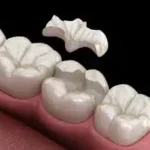 Incustraciones dentales