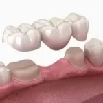 Puentes fijos o removibles