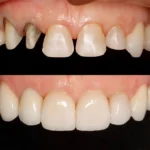 Carillas Dentales