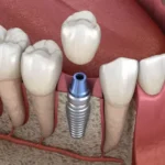 implantes dentales